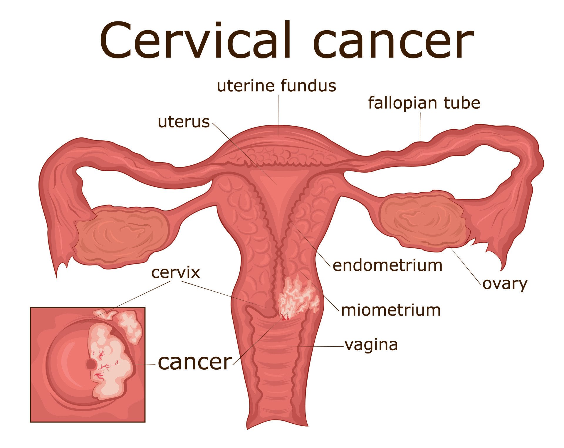 Cervical Cancer (बच्चेदानी के मुंह का कैंसर)  