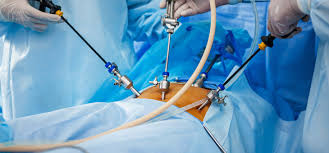 Laparoscopy    